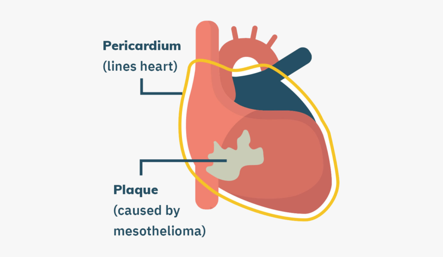 Pericardial Mesothelioma, Transparent Clipart