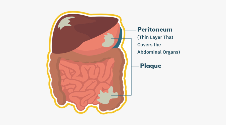 Peritoneal Mesothelioma, Transparent Clipart