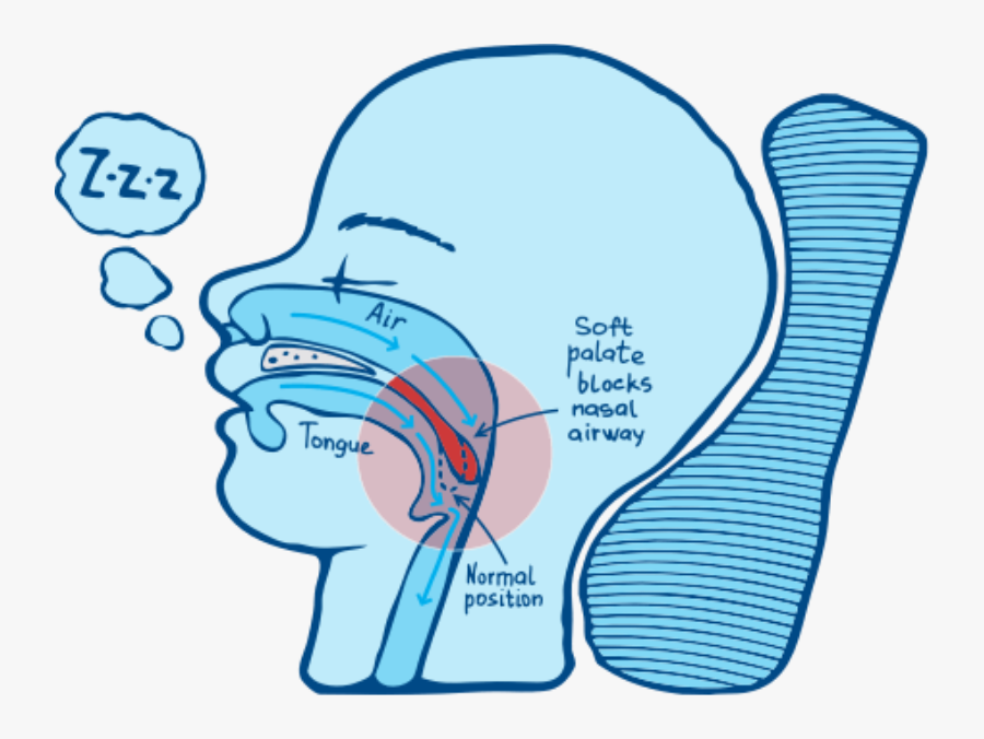 How Airsnore Works - Snoring Home Remedies, Transparent Clipart