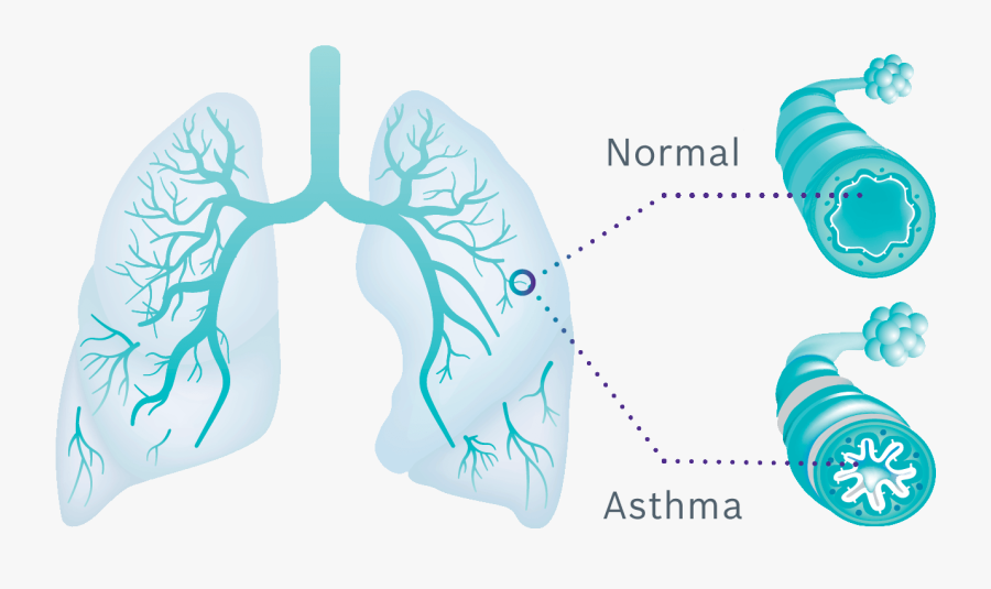 Lung Allergic Asthma - Lunge Mit Asthma, Transparent Clipart