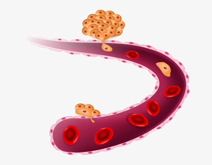 Metastasis Pancreatic Cancer, Transparent Clipart