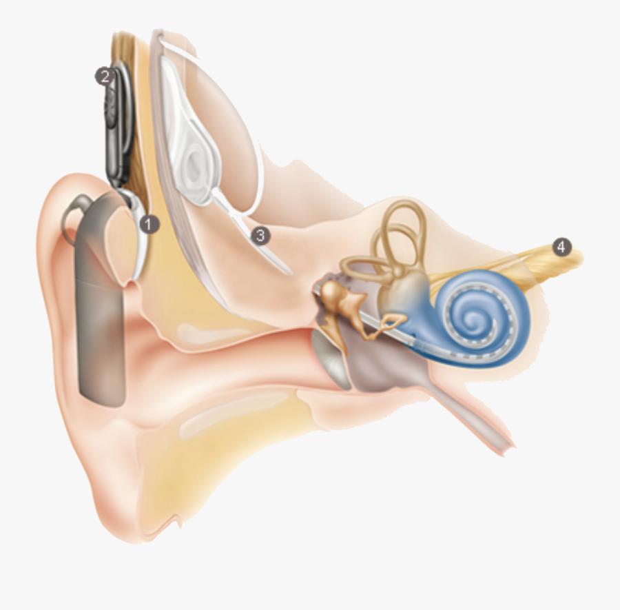 Ear Cochlear Implant, Transparent Clipart