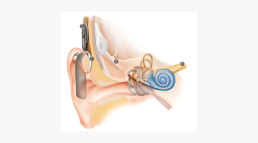 Cochlear Implant Diagram, Transparent Clipart