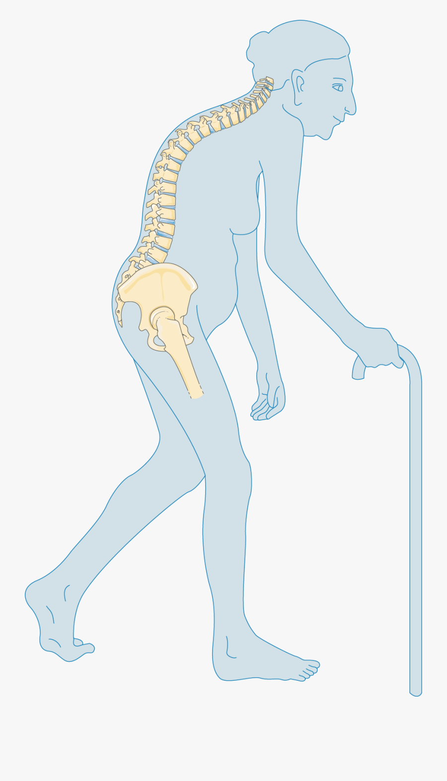 Leg Clipart Leg Fracture - Severe Osteoporosis, Transparent Clipart