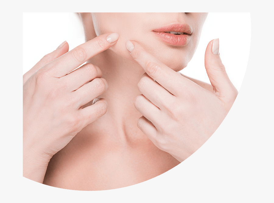 Clip Art Cystic Acne Pictures - Acne, Transparent Clipart