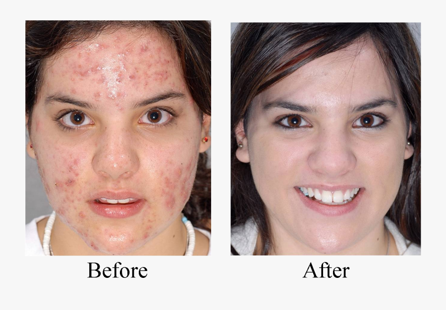 Acne Before And After Taking Zinc, Transparent Clipart
