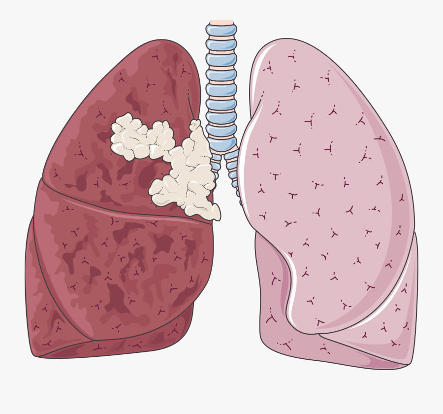 Clip Art Cancer Servier Medical Art - Ct Scan Of Smokers Lung, Transparent Clipart