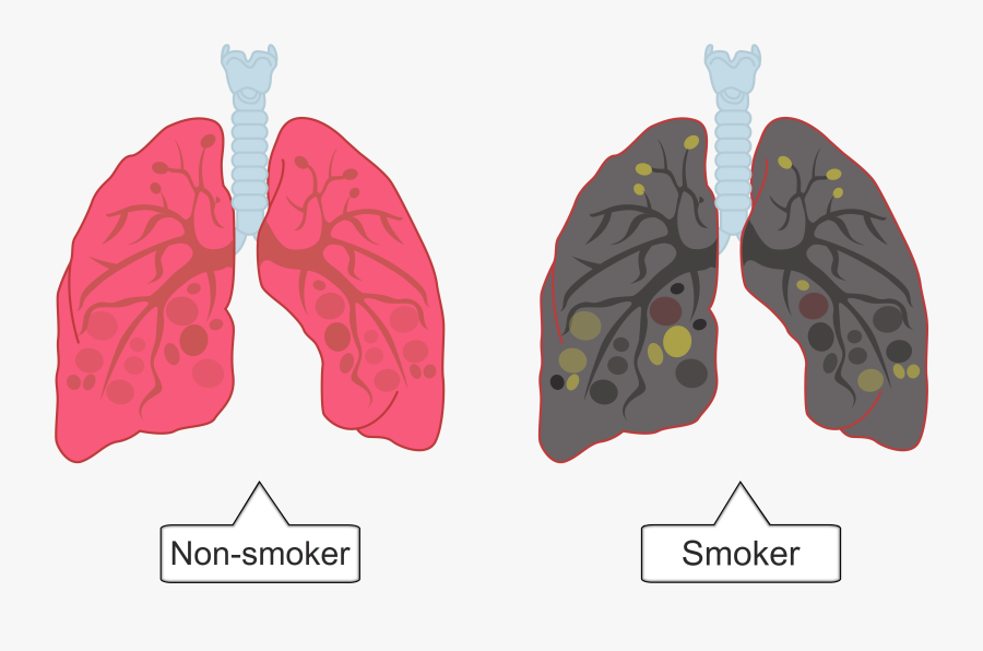 Transparent Human Body Clipart - Smokers Lungs Png Transparent, Transparent Clipart