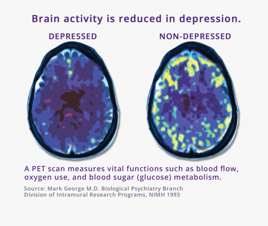 While The Exact Cause Of Depression Is Not Known, The - Tms Depression, Transparent Clipart