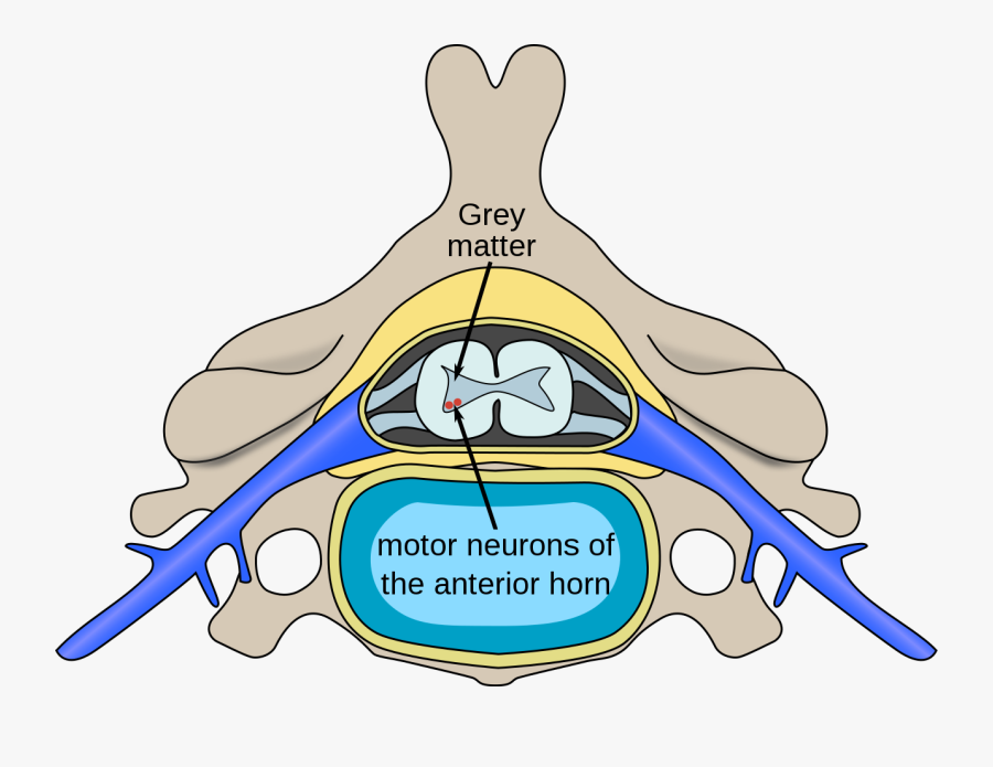 Spinal Muscular Atrophy - Polio Spinal, Transparent Clipart