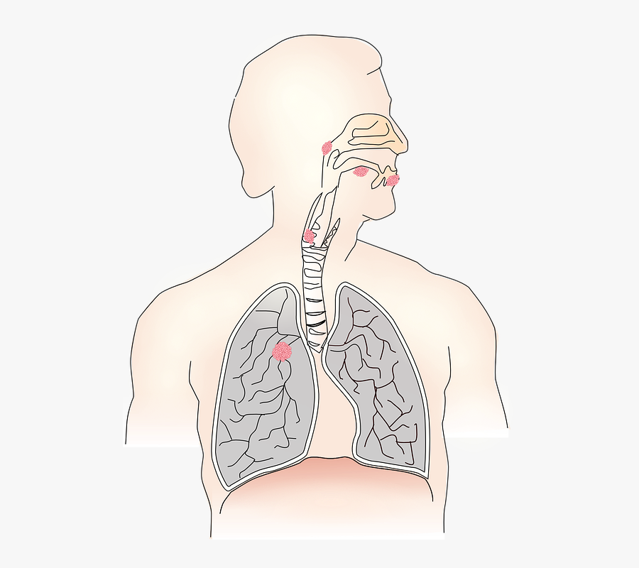 Cancer, Carcinoma, Metastases, Airway, Health, Illness - Diseases Caused Due To Pollution, Transparent Clipart