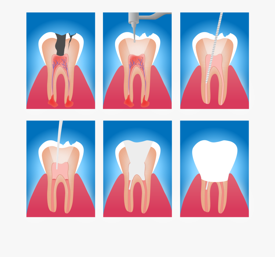 Root Canal - Root Canal Emergency Treatment, Transparent Clipart