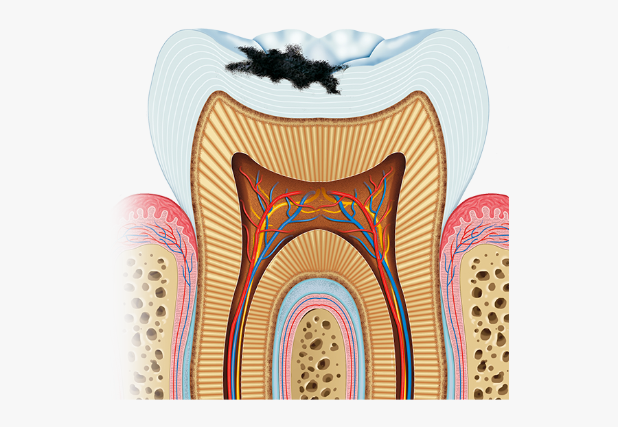 Illustration Of Decayed Tooth - Stage Two Tooth Decay, Transparent Clipart