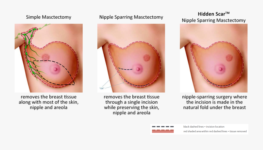 Mastectomy Surgery Options To Reduce Scars - Hidden Scar Mastectomy, Transparent Clipart