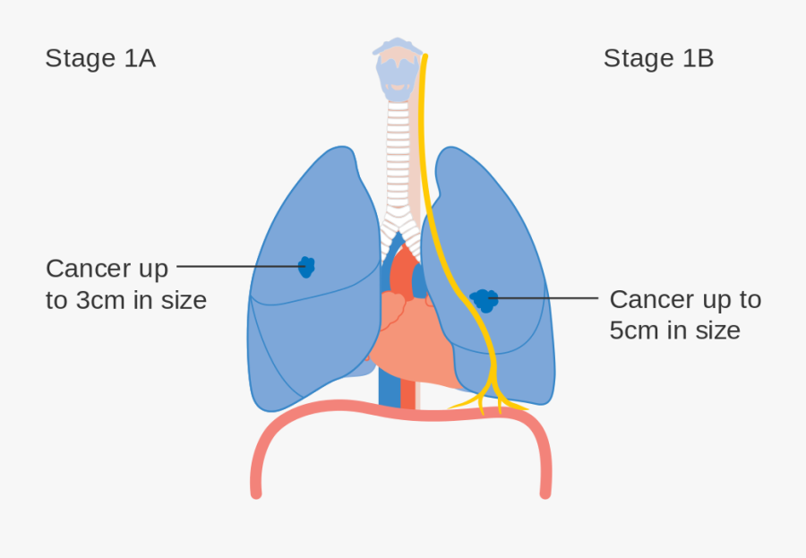 Clip Art Pictures Of Lung Cancer - Lung Cancer Staging Diagram, Transparent Clipart