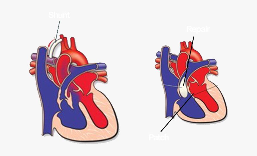 Tetralogy Of Fallot Heart, Transparent Clipart