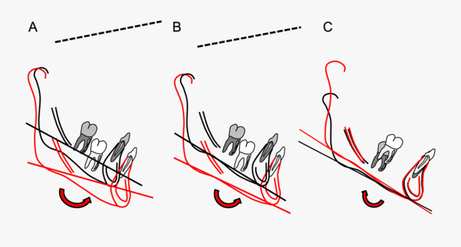 True Or Total Rotation Of The Mandible"s Implant Or - Bjork Mandibular Rotation, Transparent Clipart