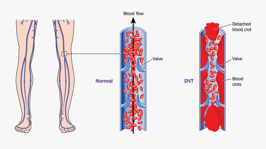 Deep Vein Thrombosis - Deep Vein Thrombosis And Pulmonary Embolism, Transparent Clipart
