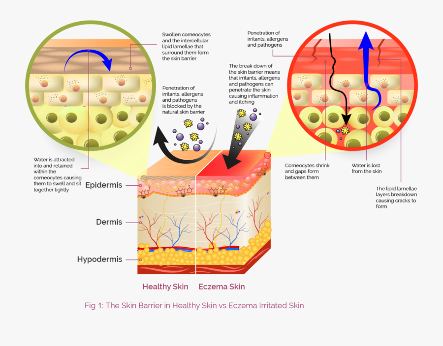 Blocked Clipart Barrier - Eczema Skin Vs Normal Skin, Transparent Clipart