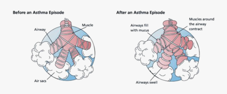 Bronchial Asthma, Transparent Clipart