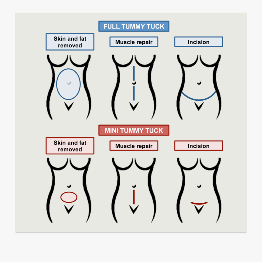 Tummy Tuck Singapore, Transparent Clipart