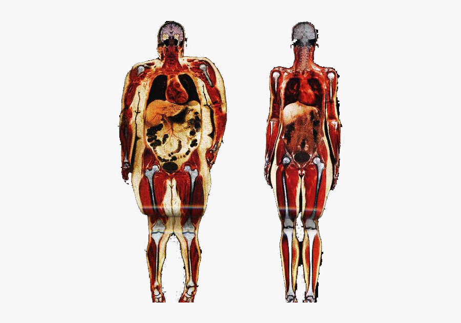 Obesity Human Body Adipose Tissue Anatomy Connective - Fat Person Vs Skinny Person, Transparent Clipart