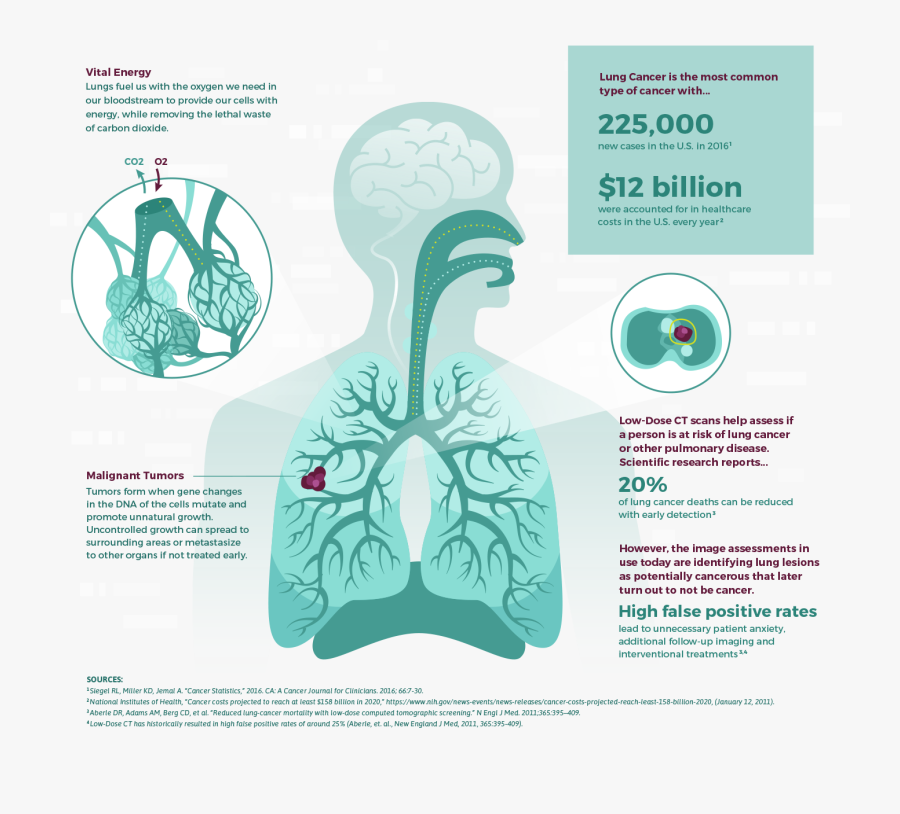 Clip Art Lung Cancer Pictures - Data Science Bowl 2017, Transparent Clipart