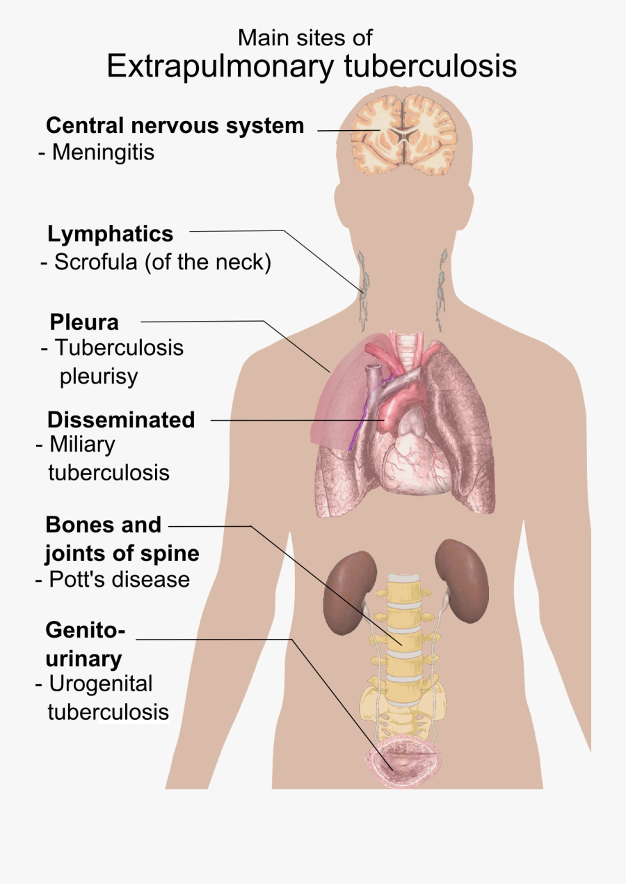 Diseases Human Body Tuberculosis - Extrapulmonary Tuberculosis, Transparent Clipart