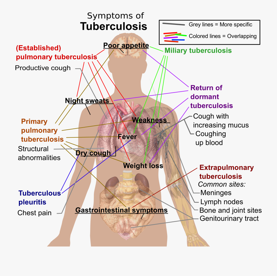 Tb Big Image Png - Clinical Picture Of Tuberculosis, Transparent Clipart