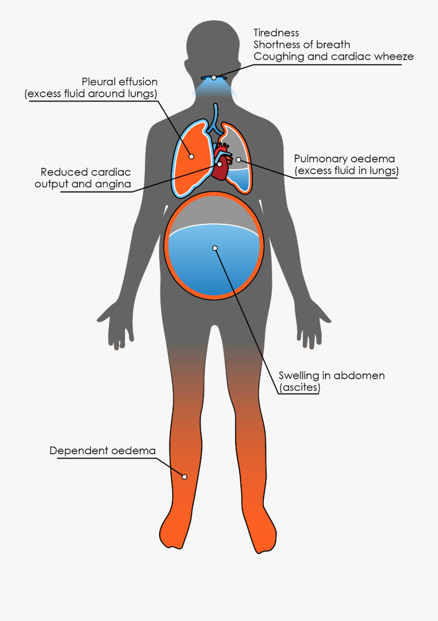 Transparent Shortness Of Breath Clipart - Ascites Heart Failure, Transparent Clipart