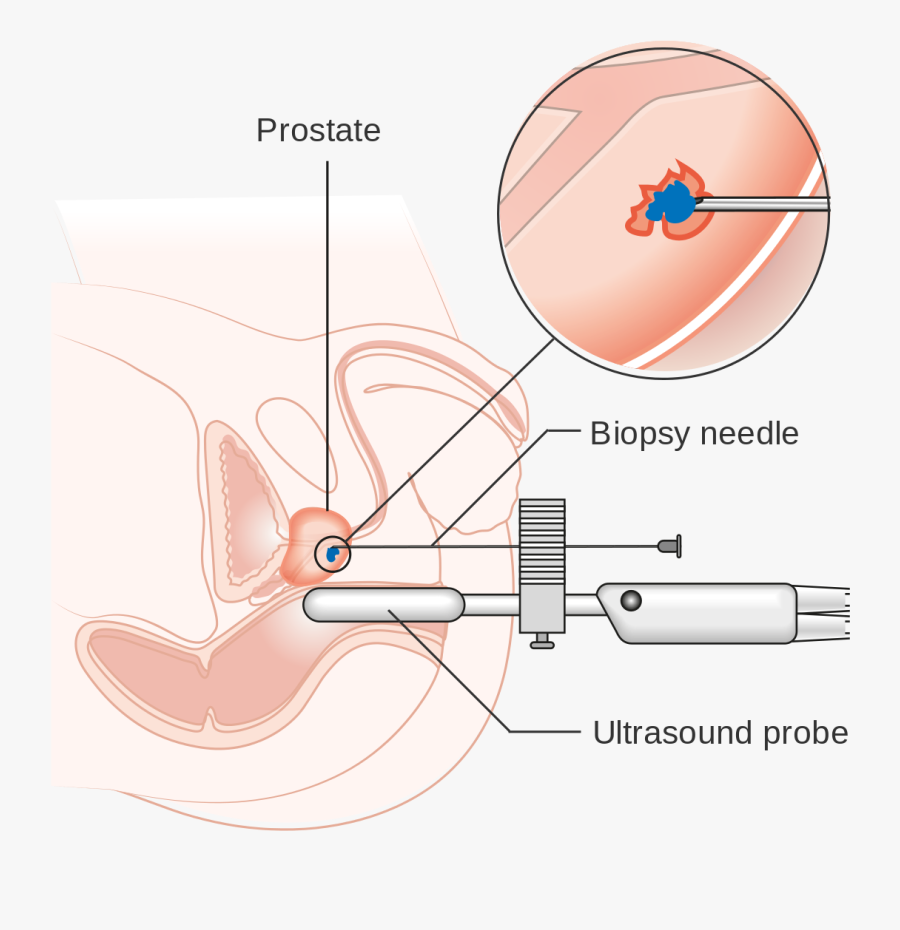 Microscope Clipart Biopsy - Transperineal Prostate Biopsy, Transparent Clipart