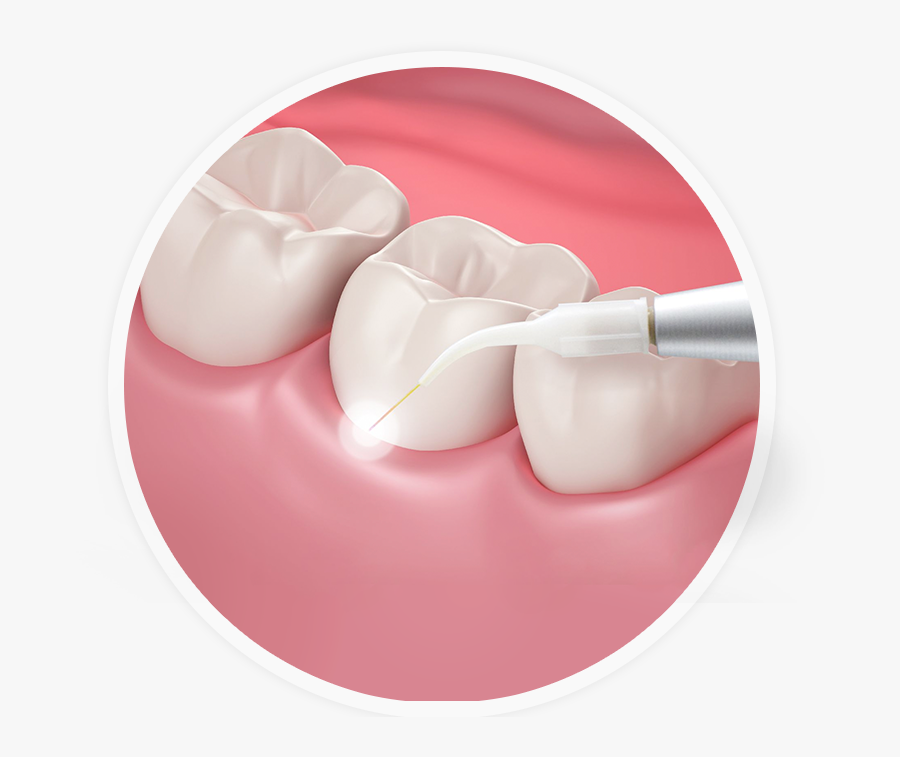 Illustration Of Laser Gum Treatment - Gums, Transparent Clipart