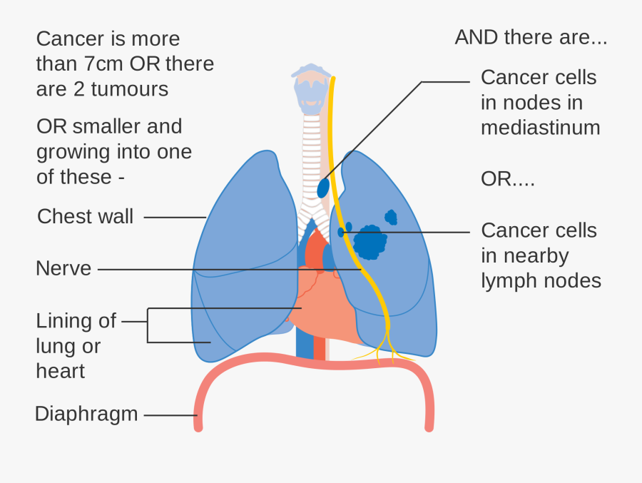 Clip Art Pictures Of Lung Cancer - Lung Cancer Ka Stage, Transparent Clipart