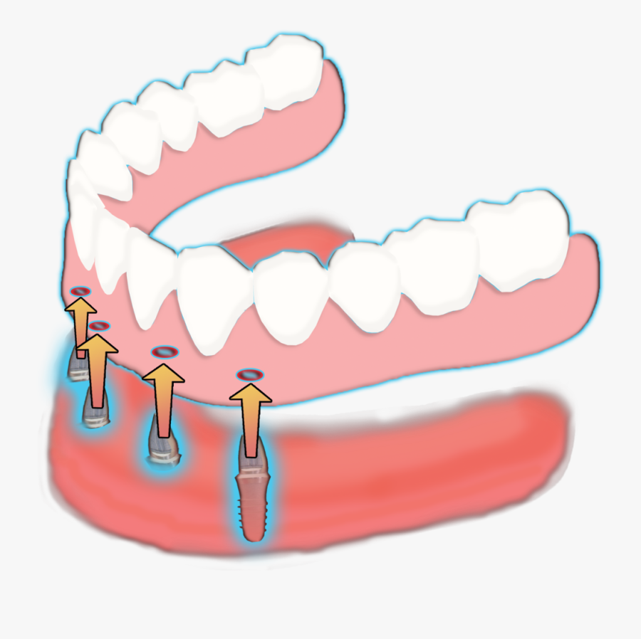 Dental Clipart Dentures, Transparent Clipart