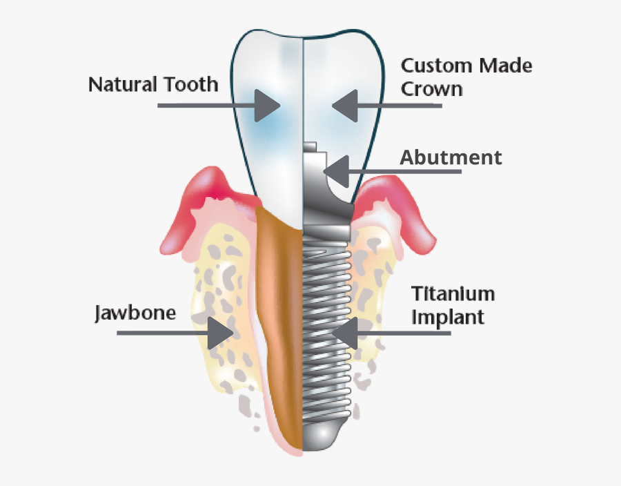 Titanium Implant - Dental Implants In Cuba, Transparent Clipart