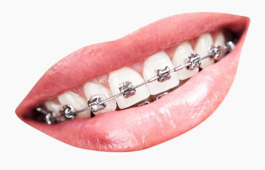 Teeth Braces Png, Transparent Clipart