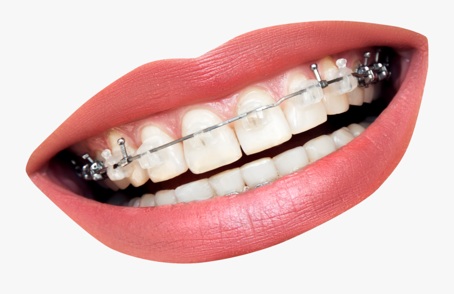 Mouth With Braces Transparent, Transparent Clipart
