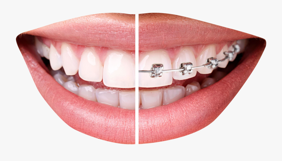 Teeth Braces Png, Transparent Clipart