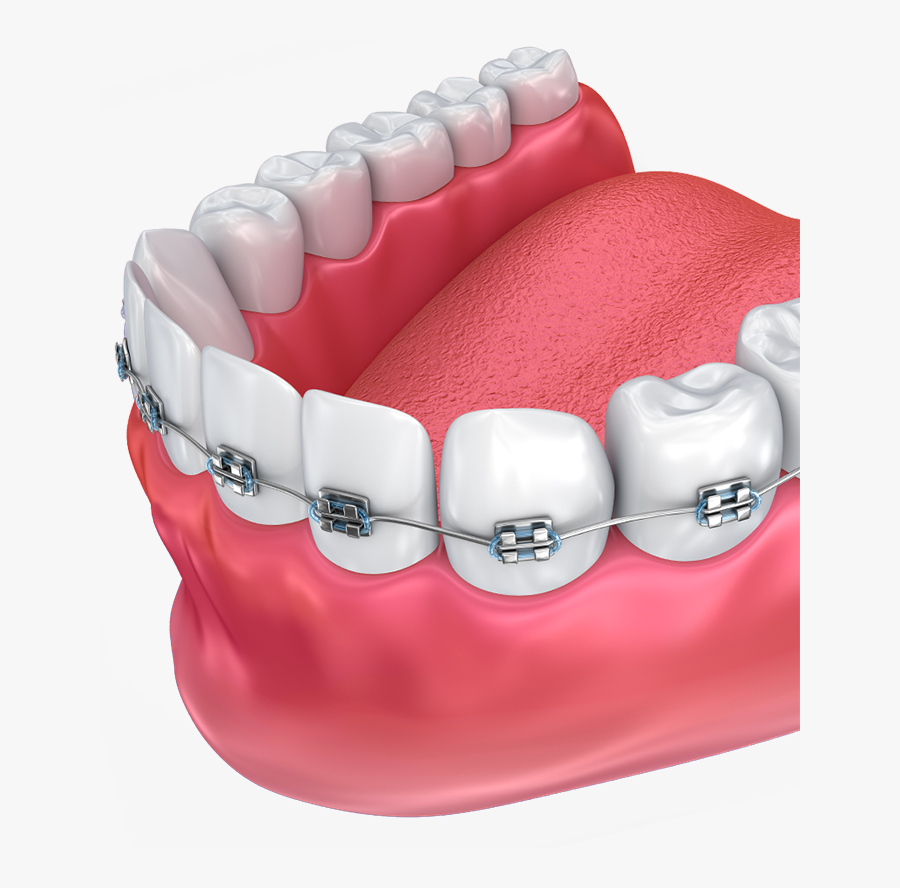 Haltom Orthodontics - Tooth Orthodontics Png, Transparent Clipart
