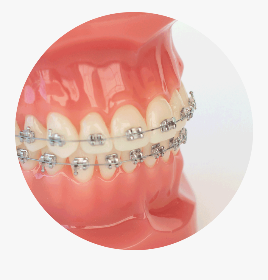 Classic Braces - Colour Braces, Transparent Clipart