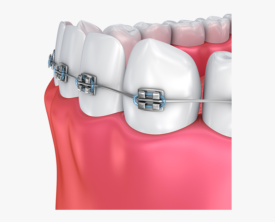 Nathaniel Podilsky - Orthodontic Treatment, Transparent Clipart