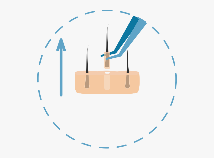 Tiny Clip Little Hair - Hair Transplant Fue Graphic, Transparent Clipart