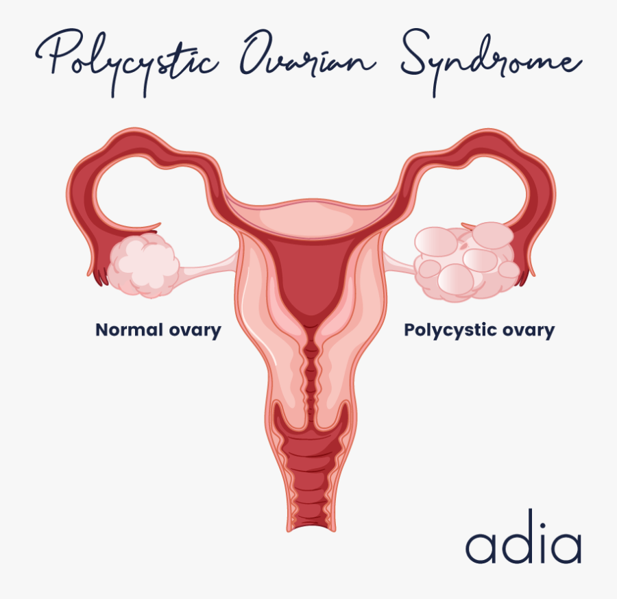 Polycystic Ovarian Syndrome - Ovarian Cancer Drawing, Transparent Clipart