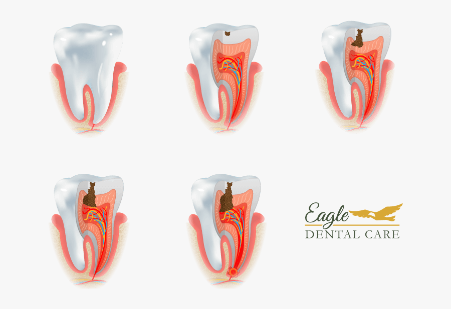 Stages Of Cavity Formation Eventually Reaching The - Human Anatomy, Transparent Clipart
