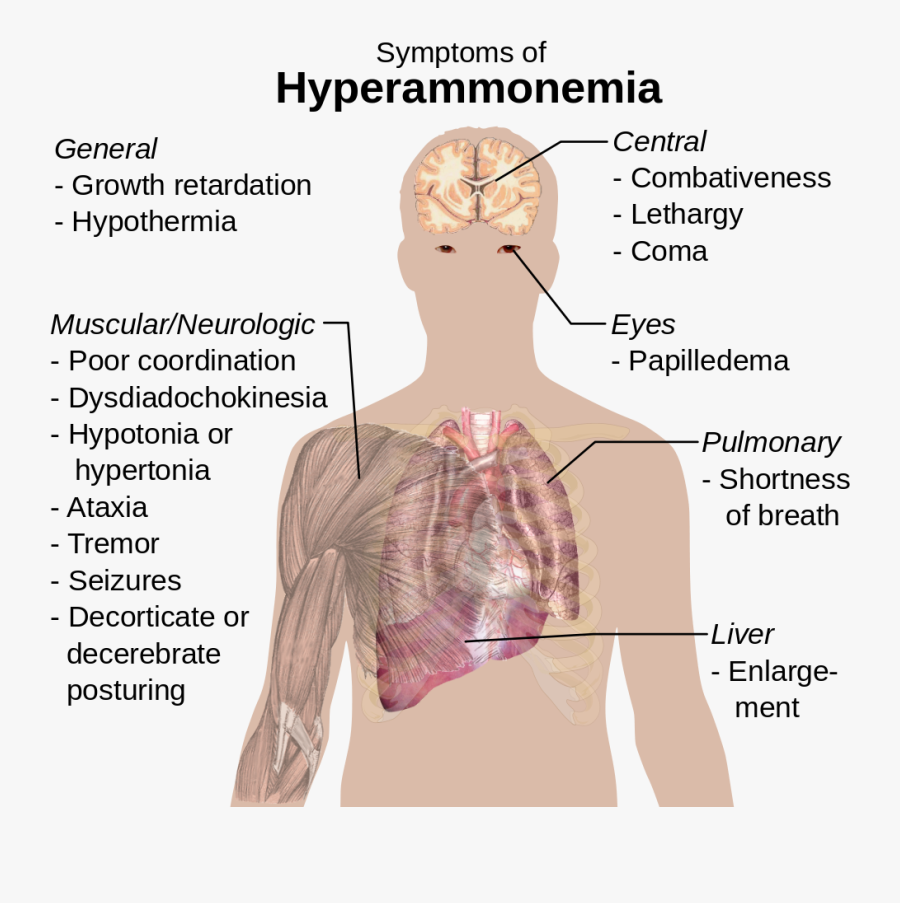 Clip Art Low Sulfur Diet - Hyperammonemia Symptoms, Transparent Clipart