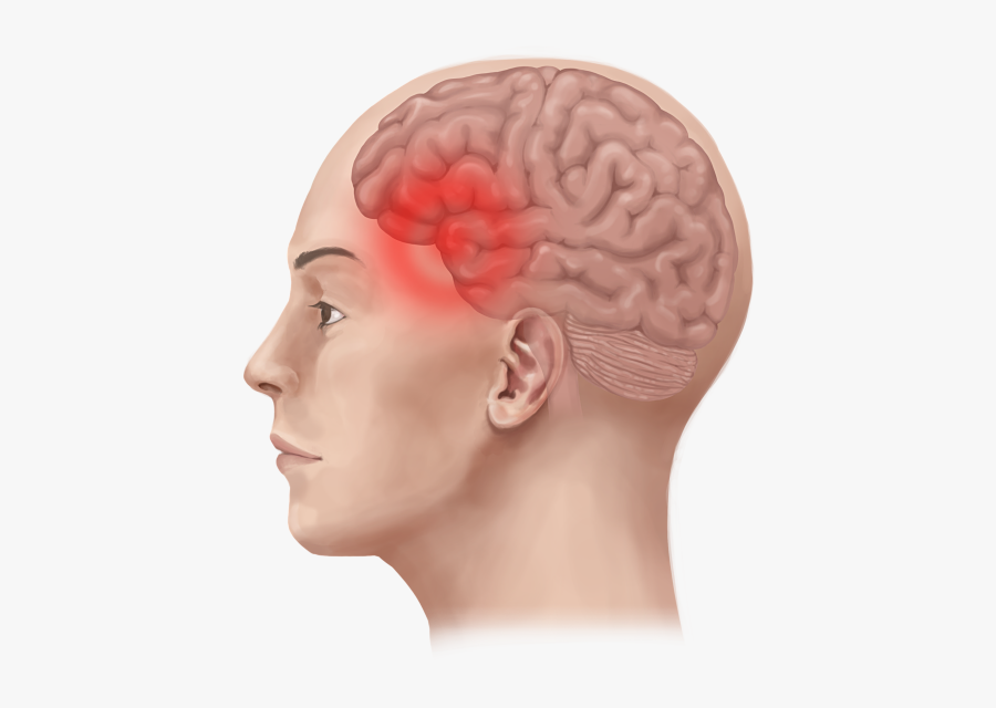 Migraine Tension Headache Therapy - Migraine Pain In Brain, Transparent Clipart