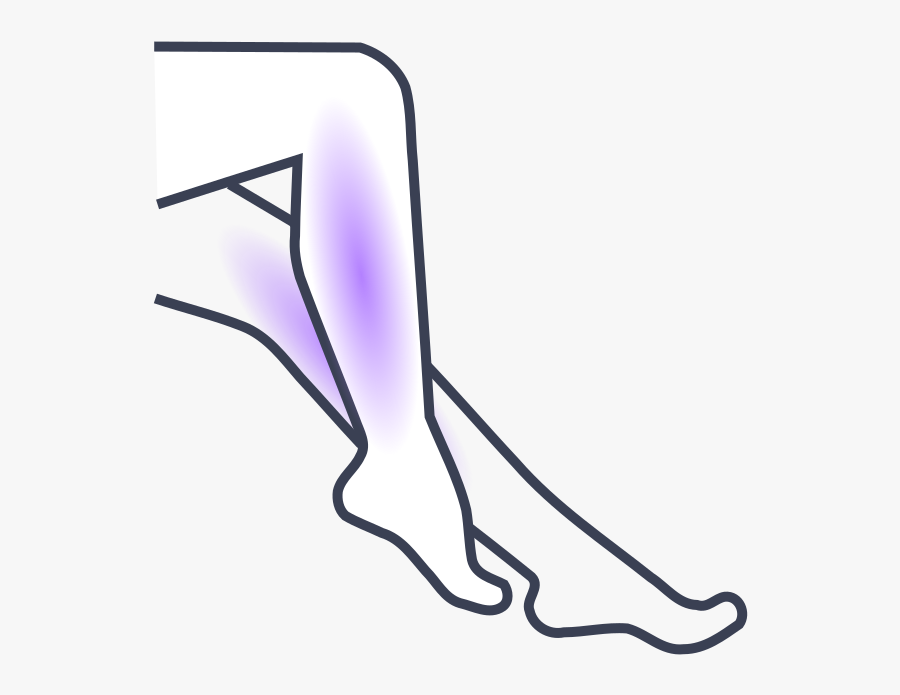 Varicose Veins, Transparent Clipart