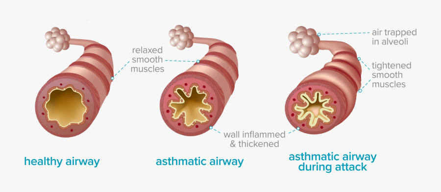 Asthma East Coast Salt - Asthma Attack, Transparent Clipart