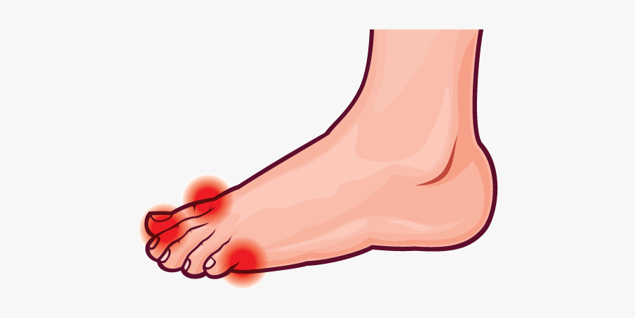 Bunions - Illustration, Transparent Clipart
