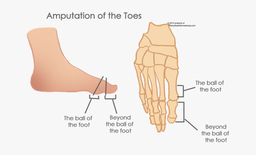 Clip Art Broken Foot Pictures - Ball Of The Big Toe, Transparent Clipart